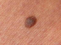 Superficial spreading melanoma