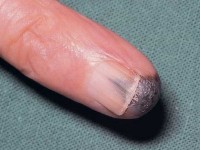 Acrolentiginous melanoma