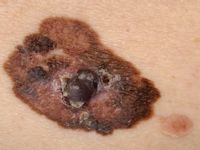 Melanoma