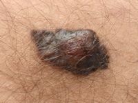 Melanoma