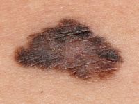 Superficial spreading melanoma