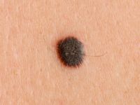 Melanoma