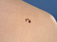 Melanoma