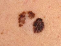 Melanoma
