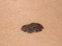 Melanoma