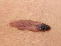 Melanoma