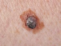 Melanoma