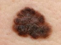 Melanoma