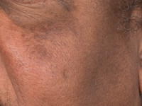 Melanodermatitis toxica