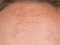 Melasma