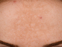 Melasma