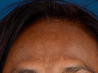 Melasma