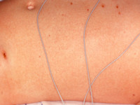 Meningococcen sepsis