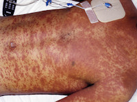 Meningococcen sepsis