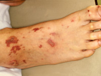 Meningococcen sepsis