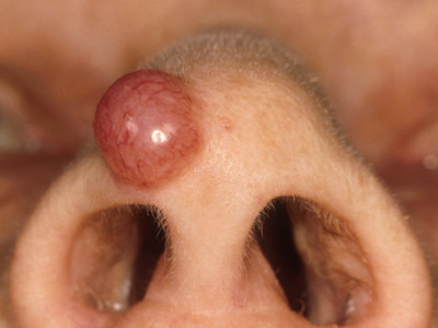 Merkel cel carcinoom