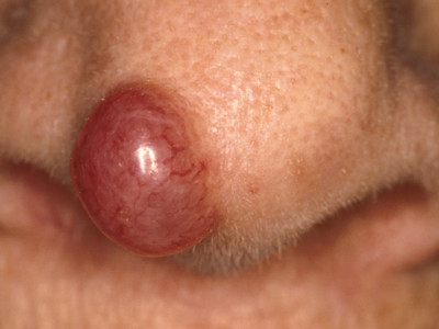 Merkel cel carcinoom