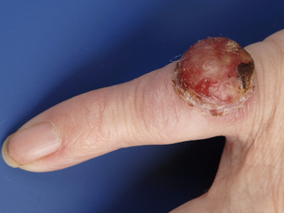 Merkel cel carcinoom