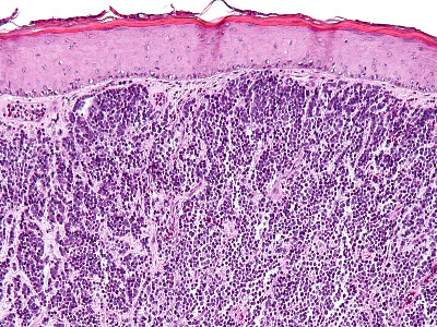 Merkel cel carcinoom