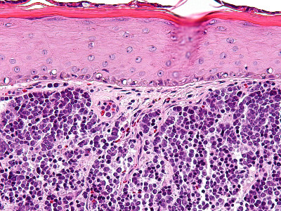 Merkel cel carcinoom
