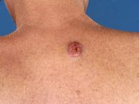 Metastase van een plaveiselcelcarcinoom naar de huid