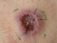 Metastase van een plaveiselcelcarcinoom naar de huid