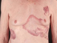 Metastase van een galblaascarcinoom naar de huid