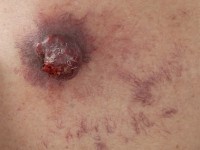 Metastase van een longcarcinoom naar de huid