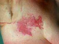 Metastase van een longcarcinoom naar de huid