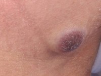 Metastase van een melanoom naar de huid