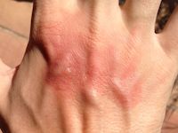 Mexican beer dermatitis (phytophotodermatitis)