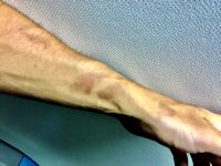 Mexican beer dermatitis (phytophotodermatitis)