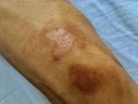 Mexican beer dermatitis (phytophotodermatitis)