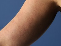 Mid-dermale elastolyse