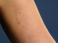 Mid-dermale elastolyse