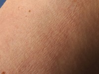 Mid-dermale elastolyse