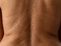 Mid-dermale elastolyse