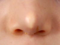 Midline nasal dermoid