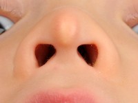 Midline nasal dermoid