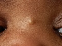 Midline nasal dermoid