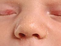 Neonatal (primary) milia