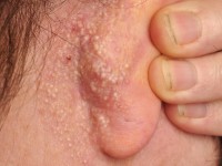 Milia en plaque, retro-auriculair