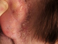 Milia en plaque, retro-auriculair