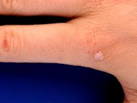 Milia en plaque, retro-auriculair