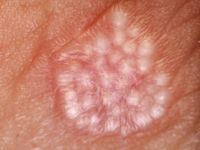 Milia en plaque, retro-auriculair