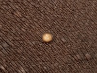 Milia-like (idiopathic) calcinosis cutis