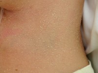 Miliaria cristallina