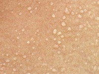 Miliaria cristallina