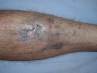 Hyperpigmentatie Minocin