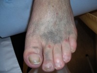 Hyperpigmentatie Minocin